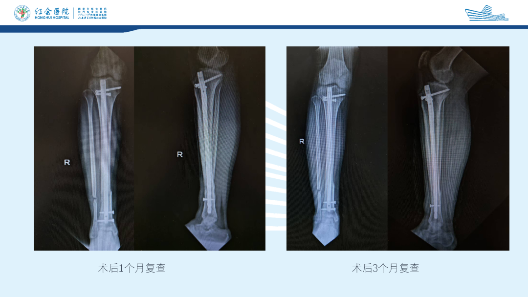 髌旁外侧入路胫骨髓内钉的临床应用