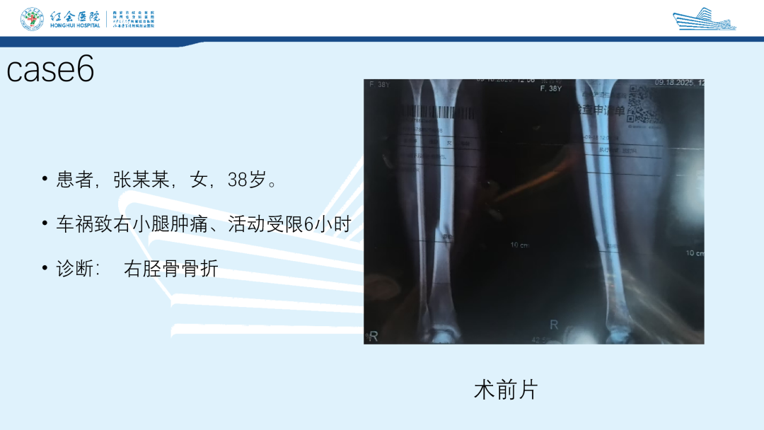 髌旁外侧入路胫骨髓内钉的临床应用