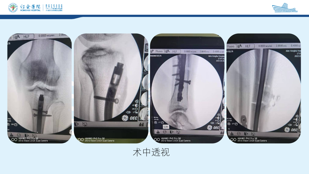 髌旁外侧入路胫骨髓内钉的临床应用