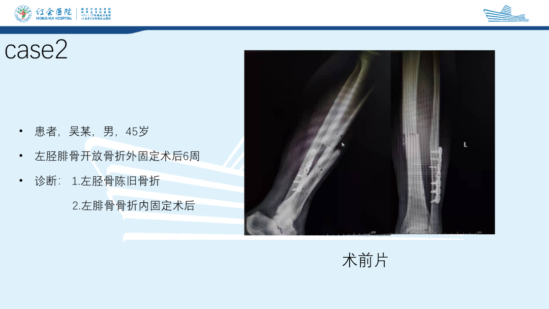 髌旁外侧入路胫骨髓内钉的临床应用