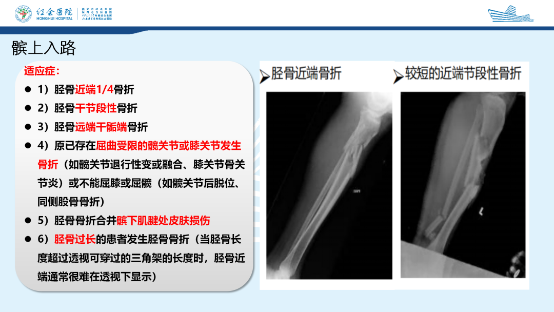 髌旁外侧入路胫骨髓内钉的临床应用