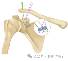 肩锁关节脱位，袢钢板还是钩钢板？