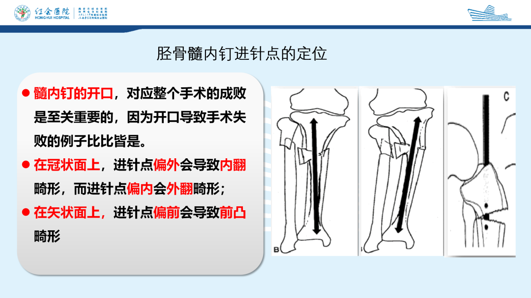 髌旁外侧入路胫骨髓内钉的临床应用