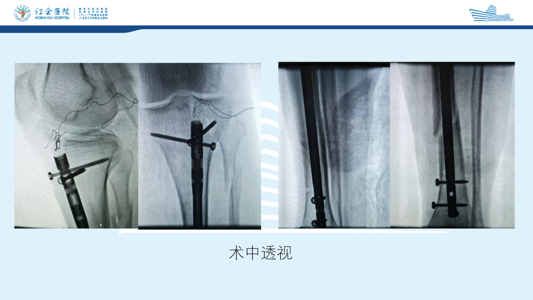 髌旁外侧入路胫骨髓内钉的临床应用