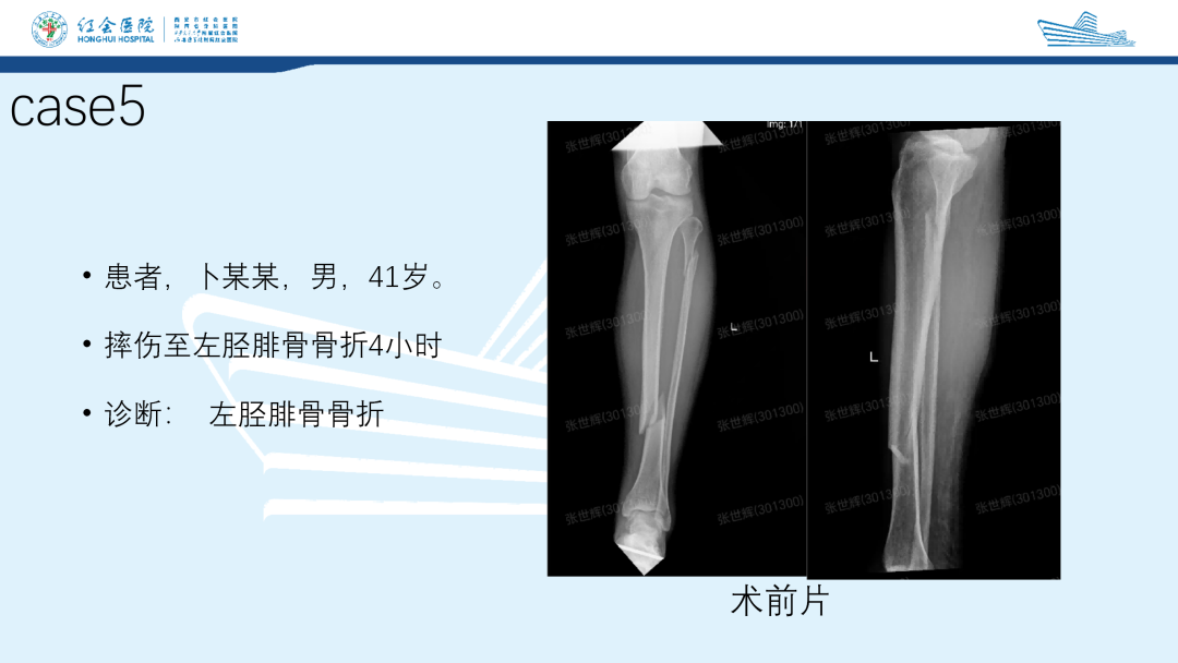 髌旁外侧入路胫骨髓内钉的临床应用