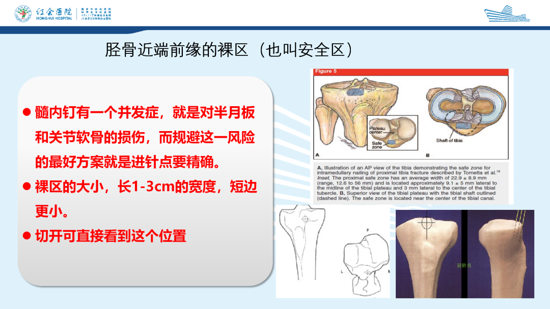 髌旁外侧入路胫骨髓内钉的临床应用