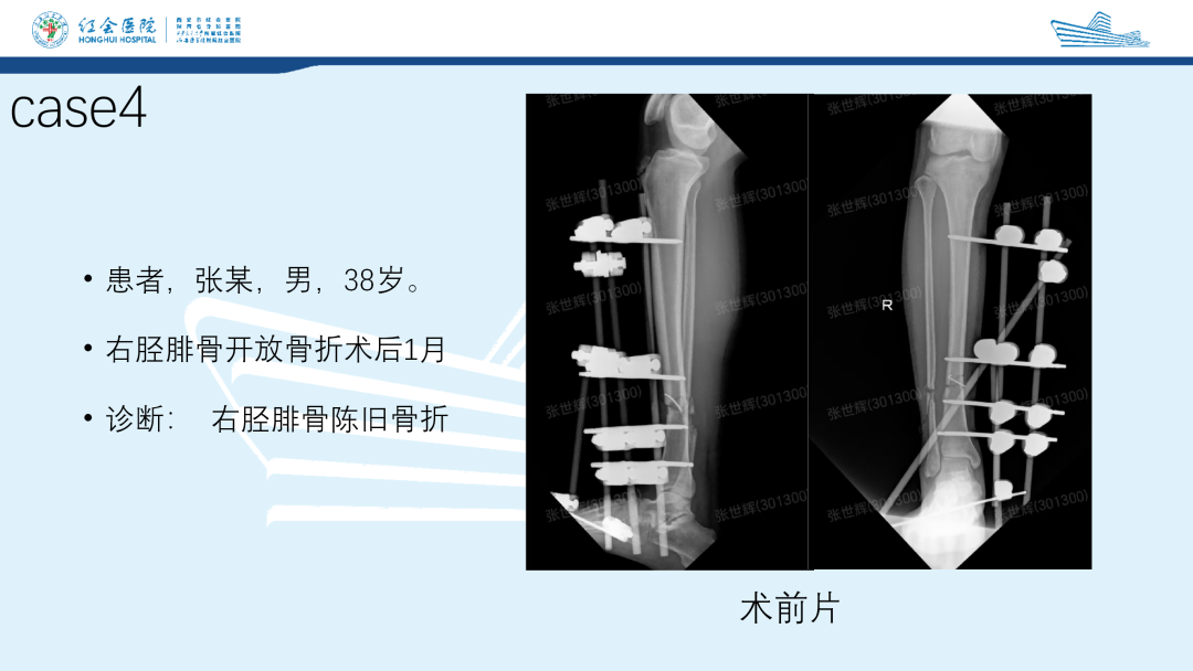 髌旁外侧入路胫骨髓内钉的临床应用