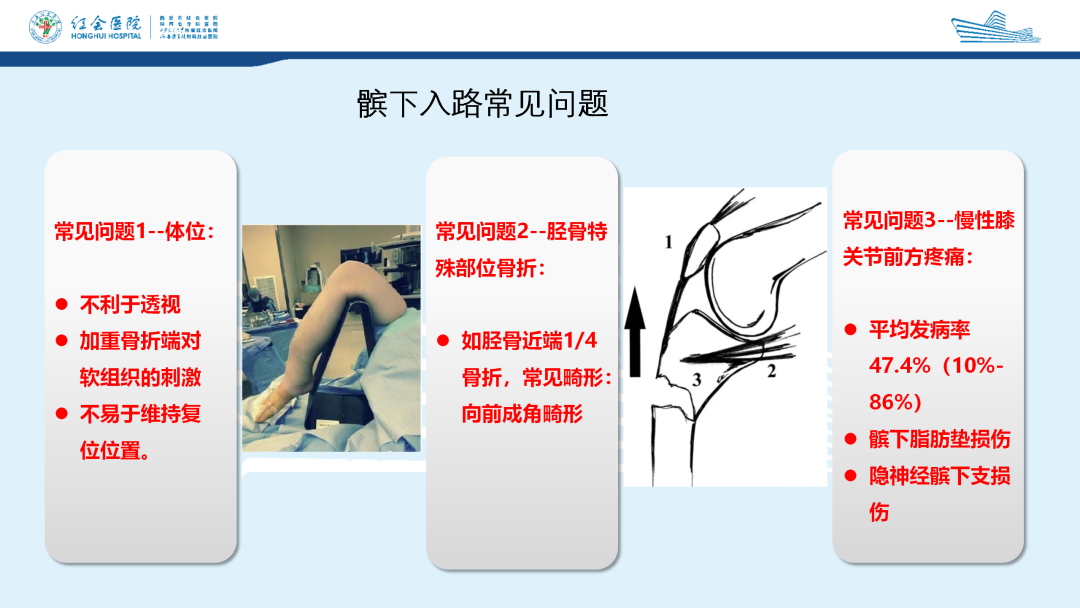 髌旁外侧入路胫骨髓内钉的临床应用