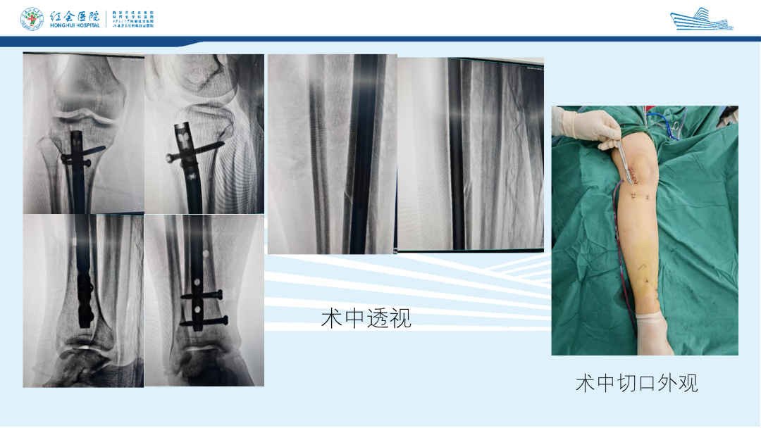 髌旁外侧入路胫骨髓内钉的临床应用