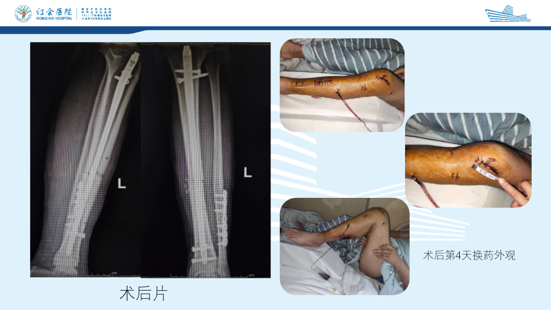 髌旁外侧入路胫骨髓内钉的临床应用