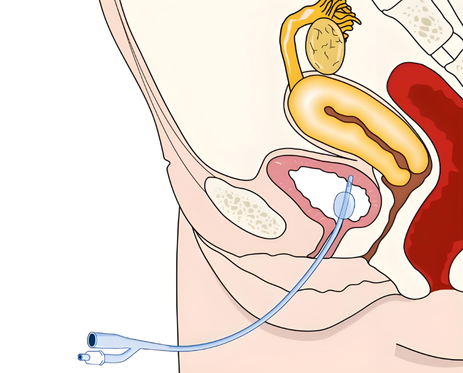 怎么使用集尿袋“石”话实说 ｜ 泉小护健康课堂第八十六期——常用留置导管居家护理规范之导尿管_https://www.jmylbn.com_新闻资讯_第4张
