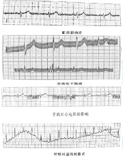 病人监护仪怎么用监护仪的使用丨基本监测参数_https://www.jmylbn.com_新闻资讯_第4张
