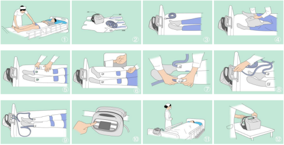 全科诊疗仪是什么神奇的“防栓利器”：间歇充气加压装置｜安阳地区医院全科医疗科特色诊疗系列_https://www.jmylbn.com_新闻资讯_第7张