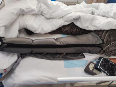 全科诊疗仪是什么神奇的“防栓利器”：间歇充气加压装置｜安阳地区医院全科医疗科特色诊疗系列_https://www.jmylbn.com_新闻资讯_第9张