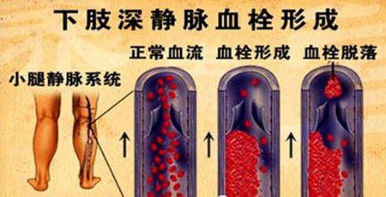 全科诊疗仪是什么神奇的“防栓利器”：间歇充气加压装置｜安阳地区医院全科医疗科特色诊疗系列_https://www.jmylbn.com_新闻资讯_第2张