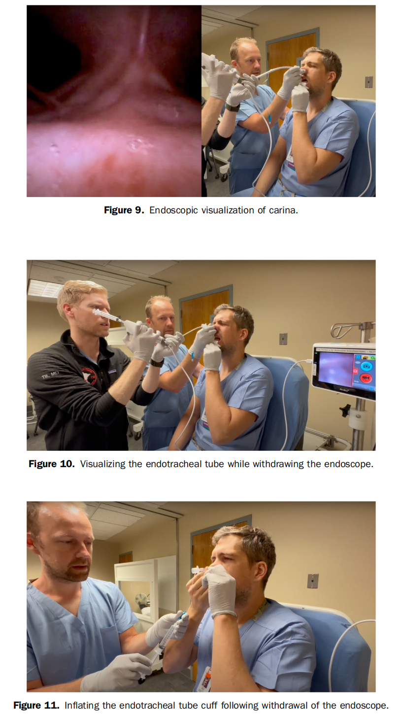 气管插管纱布怎么垫急诊仅0.4%？梅奥专家揭秘：清醒插管85%成功率的救命法则！(附详细图解)_https://www.jmylbn.com_新闻资讯_第14张