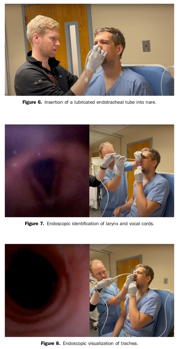 气管插管纱布怎么垫急诊仅0.4%？梅奥专家揭秘：清醒插管85%成功率的救命法则！(附详细图解)_https://www.jmylbn.com_新闻资讯_第13张