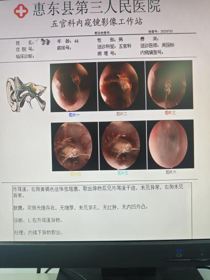 耳鼻喉内镜是什么科【医疗动态】五官科的“火眼金睛”——内窥镜检查_https://www.jmylbn.com_新闻资讯_第16张