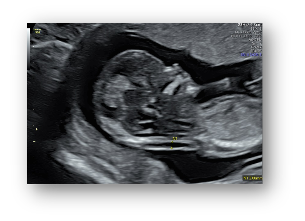 VOlusonE什么彩超机孕妈妈的福音——金普妇幼首家引进高端四维彩超-GE-Voluson金标E10_https://www.jmylbn.com_新闻资讯_第15张