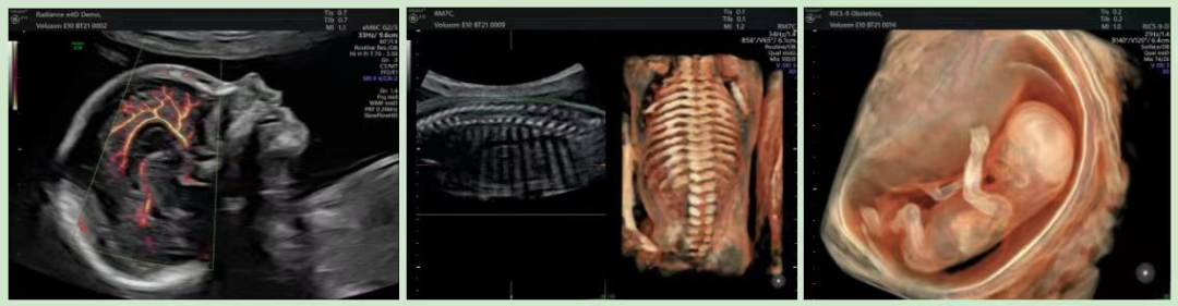 VOlusonE什么彩超机孕妈妈的福音——金普妇幼首家引进高端四维彩超-GE-Voluson金标E10_https://www.jmylbn.com_新闻资讯_第9张