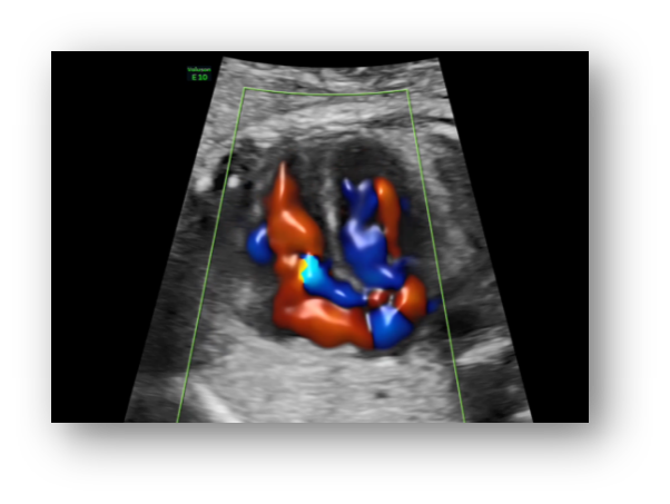 VOlusonE什么彩超机孕妈妈的福音——金普妇幼首家引进高端四维彩超-GE-Voluson金标E10_https://www.jmylbn.com_新闻资讯_第17张