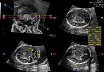 VOlusonE什么彩超机孕妈妈的福音——金普妇幼首家引进高端四维彩超-GE-Voluson金标E10_https://www.jmylbn.com_新闻资讯_第16张