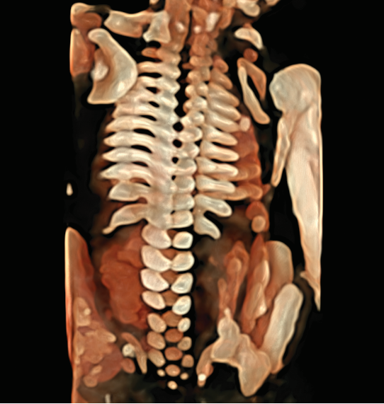 VOlusonE什么彩超机孕妈妈的福音——金普妇幼首家引进高端四维彩超-GE-Voluson金标E10_https://www.jmylbn.com_新闻资讯_第12张