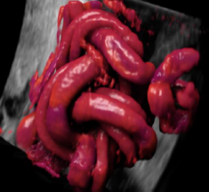 VOlusonE什么彩超机孕妈妈的福音——金普妇幼首家引进高端四维彩超-GE-Voluson金标E10_https://www.jmylbn.com_新闻资讯_第13张