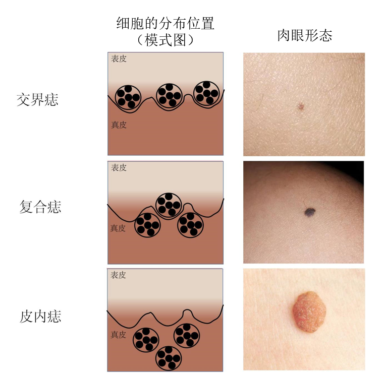 其中交界痣最为常见.