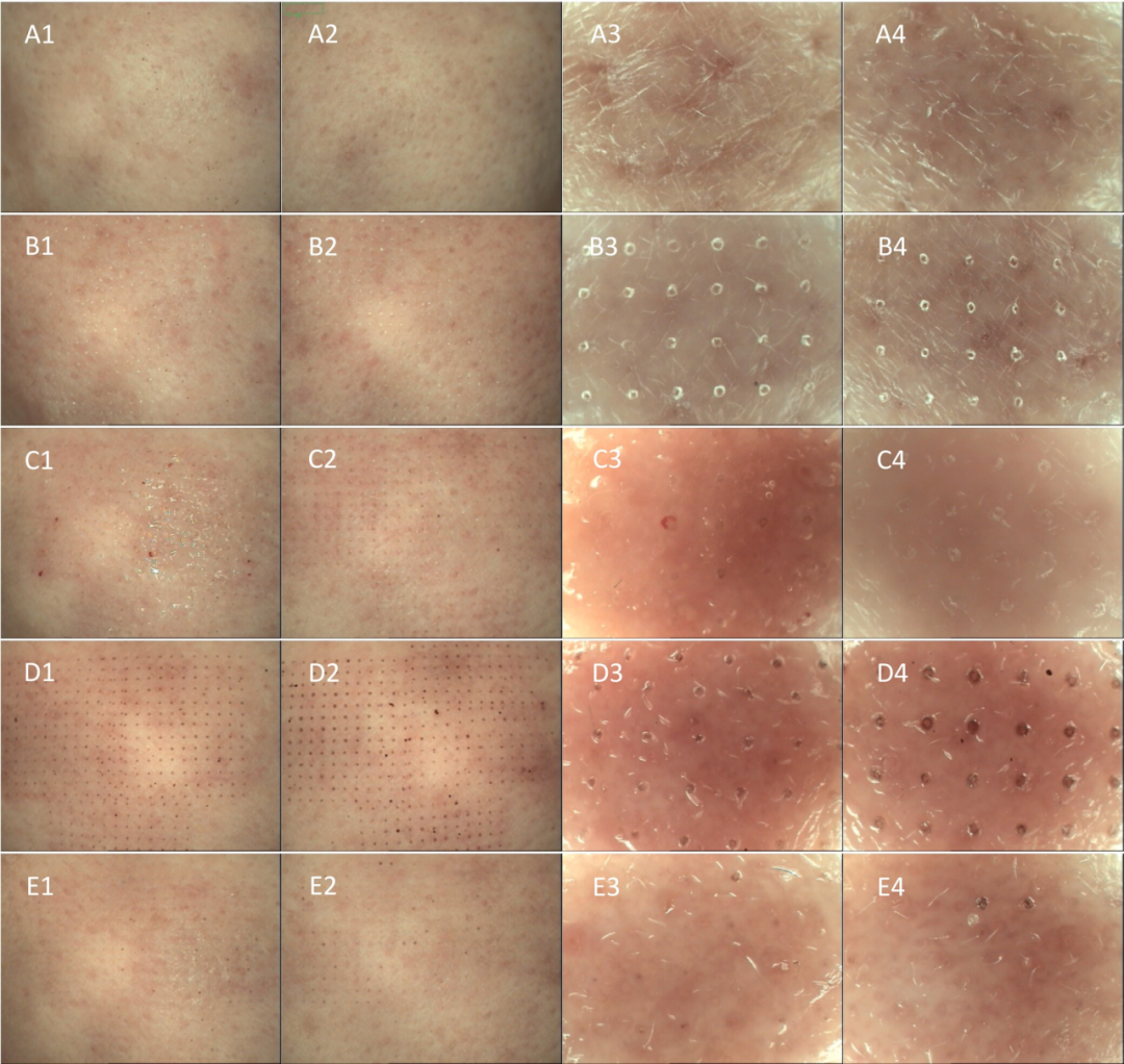 点阵激光后冷敷怎么敷红霉素眼膏 vs 冷敷贴：CO₂点阵激光治疗后伤口愈合比较_https://www.jmylbn.com_新闻资讯_第7张