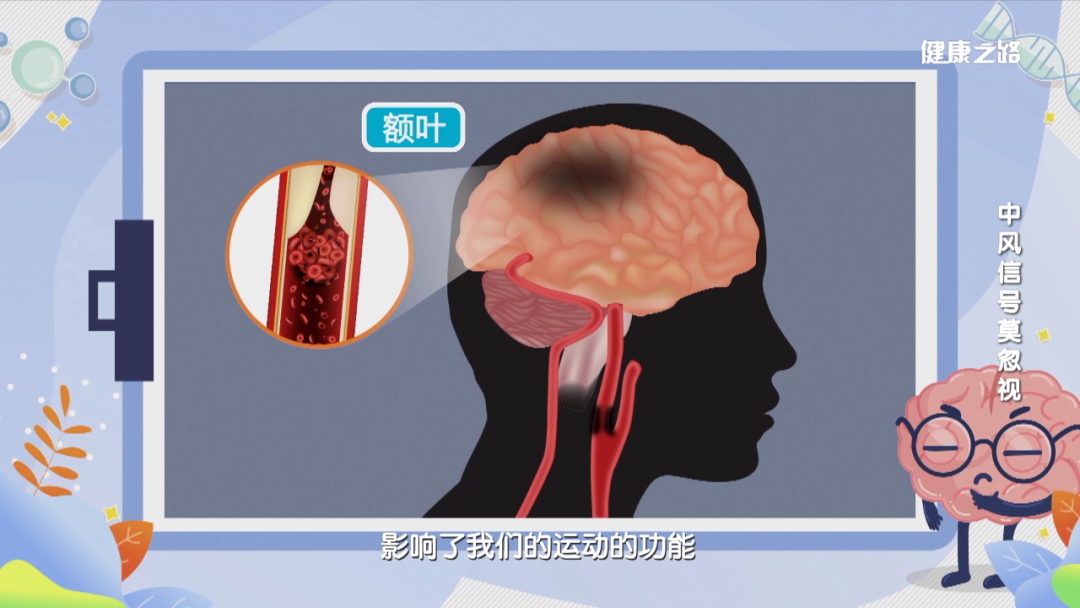 小脑由椎基底动脉供血,当椎基底动脉发生狭窄或硬化,会导致脑细胞因