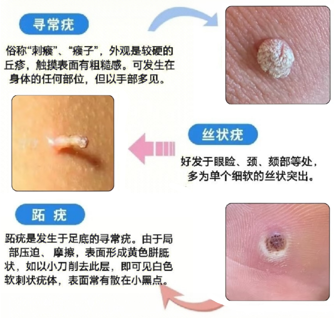 人乳头瘤病毒是什么意思