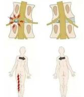 悬吊训练系统 怎么装椎间盘突出引发脊柱侧弯问题，如何通过针灸推拿+悬吊训练恢复身体平衡？_https://www.jmylbn.com_新闻资讯_第10张