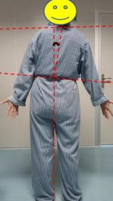 悬吊训练系统 怎么装椎间盘突出引发脊柱侧弯问题，如何通过针灸推拿+悬吊训练恢复身体平衡？_https://www.jmylbn.com_新闻资讯_第4张