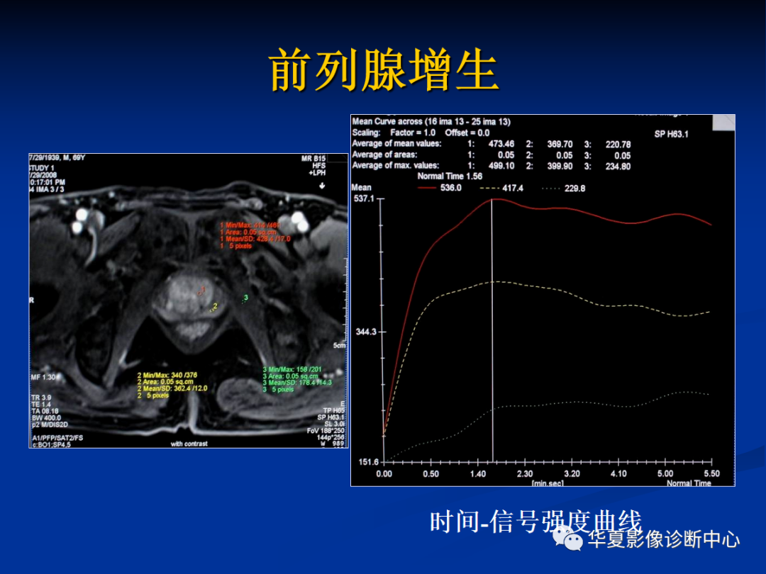 前列腺癌磁共振成像诊断