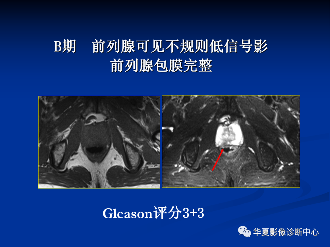 前列腺癌磁共振成像诊断