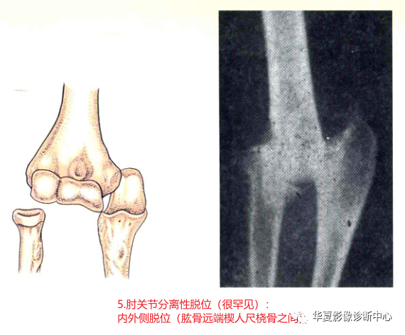 3,肘關節外脫位.尺橈骨向前方脫位.2,肘關節前脫位.80%以上為後