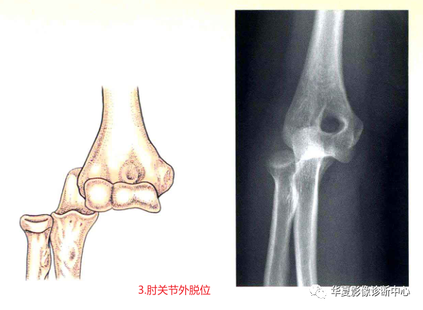 3,肘關節外脫位.尺橈骨向前方脫位.2,肘關節前脫位.80%以上為後