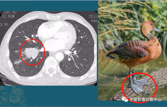 ct片怎样分辨小细胞肺癌?_医学界-助力医生临床决策和职业成长