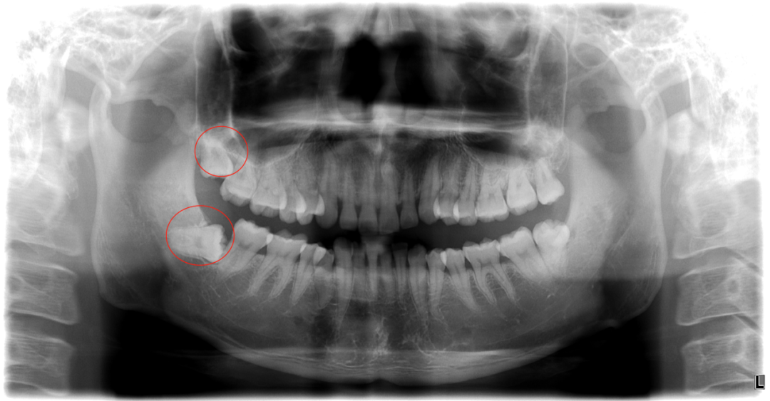 牙科骨凿怎么用想象中的拔牙VS现实中的拔牙_https://www.jmylbn.com_新闻资讯_第3张