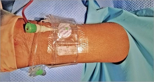 动脉什么压迫止血桡动脉压迫时间还能缩短吗？_https://www.jmylbn.com_新闻资讯_第4张