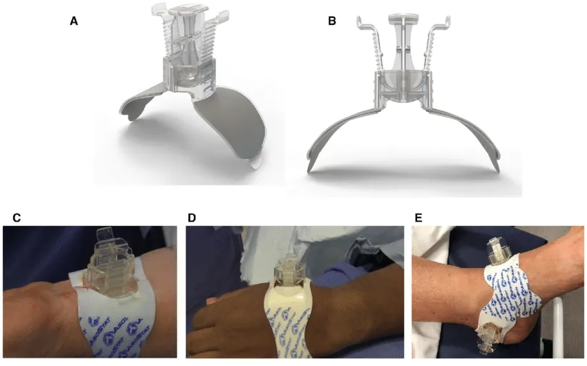 动脉什么压迫止血桡动脉压迫时间还能缩短吗？_https://www.jmylbn.com_新闻资讯_第3张