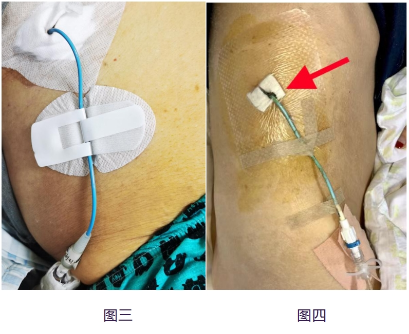 导管引流贴怎么贴长期留置引流管患者的护理攻略_https://www.jmylbn.com_新闻资讯_第4张