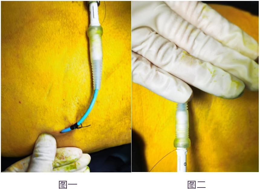 导管引流贴怎么贴长期留置引流管患者的护理攻略_https://www.jmylbn.com_新闻资讯_第3张