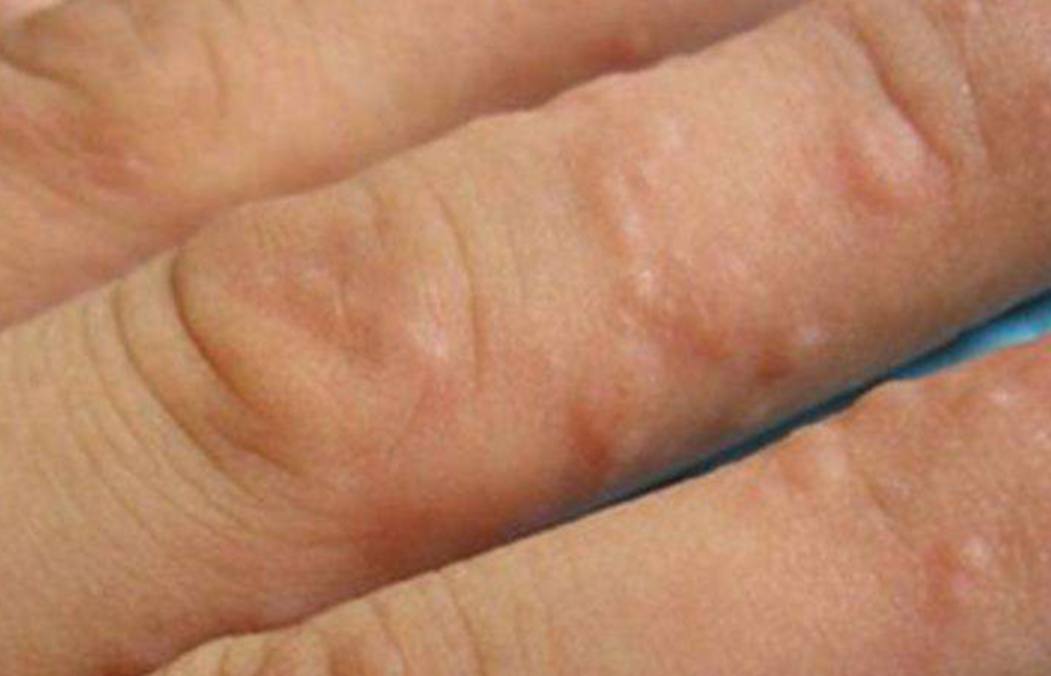 青羊区皮肤病研究所揭秘：水疱型手癣？一招搞定！