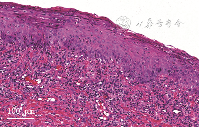 半导体激光治疗什么病临床典型病例分析 ｜ 半导体激光治疗难治性口腔扁平苔藓1例_https://www.jmylbn.com_新闻资讯_第5张