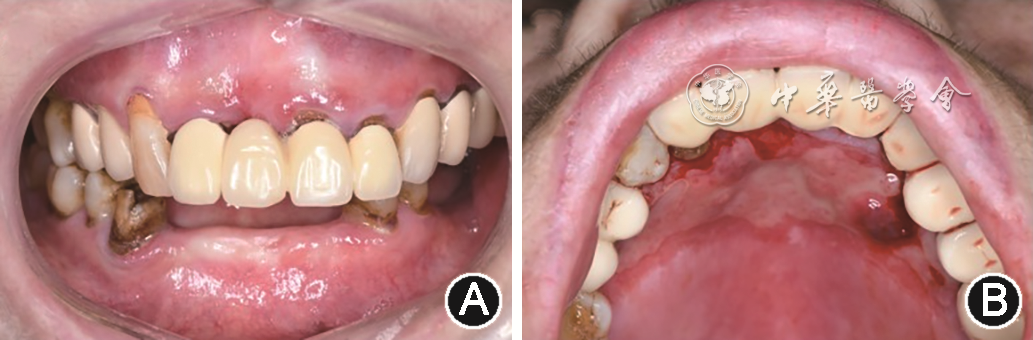 半导体激光治疗什么病临床典型病例分析 ｜ 半导体激光治疗难治性口腔扁平苔藓1例_https://www.jmylbn.com_新闻资讯_第4张
