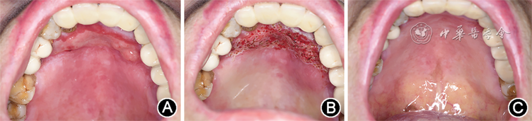 半导体激光治疗什么病临床典型病例分析 ｜ 半导体激光治疗难治性口腔扁平苔藓1例_https://www.jmylbn.com_新闻资讯_第6张