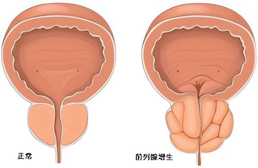 lep刀是什么专病精治丨余杭三院开展首例经尿道大禹刀前列腺剜除术-上海聚慕医疗器械有限公司