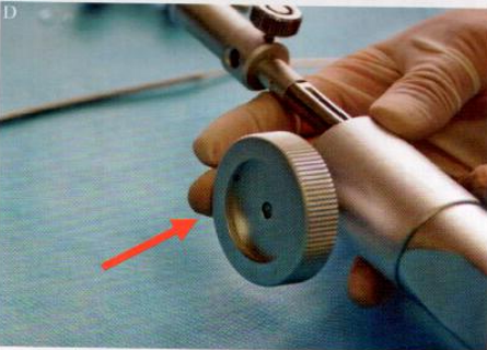 取石网篮为什么这么贵【ERCP护理】内镜下机械碎石取石术护理配合_https://www.jmylbn.com_新闻资讯_第17张